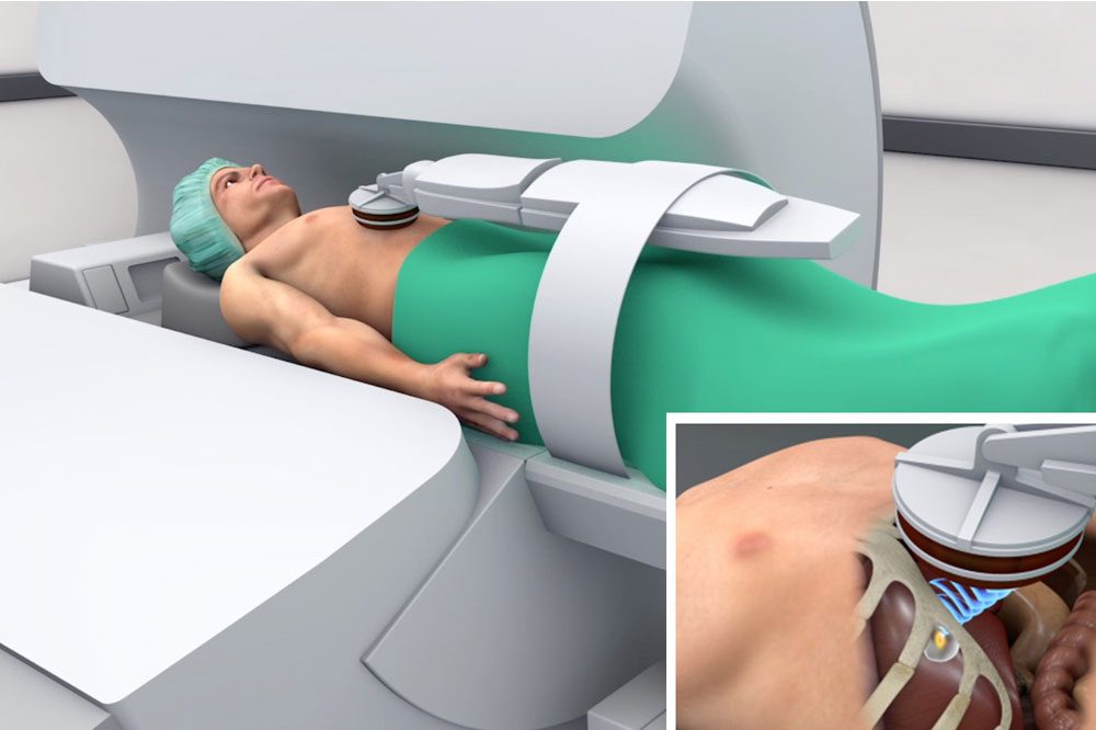 Schematische Darstellung zur Anwendung des fokussierten Ultraschalls im MRT. Foto: Fraunhofer MEVIS