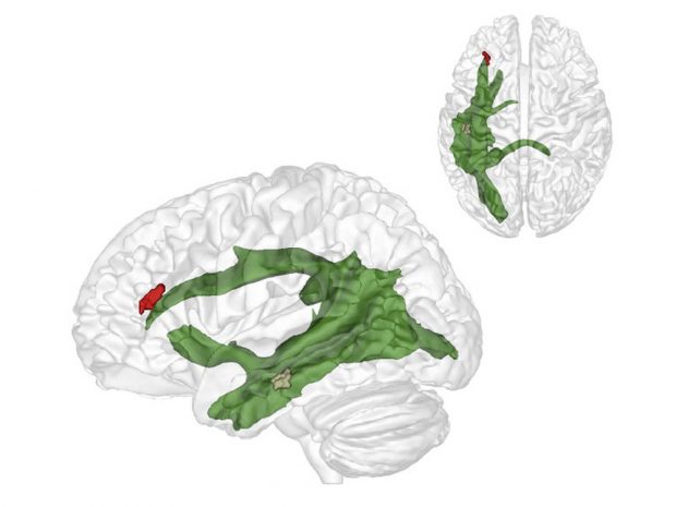 Als eine Art Datenautobahn verknüpft der Fasciculus Arcuatus (grün) ab etwa dem vierten Lebensjahr zwei wesentliche Hirnareale miteinander: Eine Region im hinteren Schläfenlappen (braun), die uns im Erwachsenenalter hilft, über andere Menschen und deren Gedanken nachzudenken, und ein Areal im Frontallappen im vorderen Großhirn (rot), das uns vermutlich dabei hilft die Gedanken anderer und die wirkliche Welt auf anderen Abstraktionsebenen zu halten. Grafik: MPI CBS