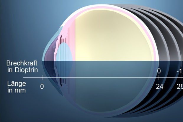 Ein zu großer Augapfel führt zu starker Kurzsichtigkeit. Foto: René Hänsel, Universität Leipzig
