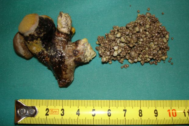 Nierensteine. Foto: UKL