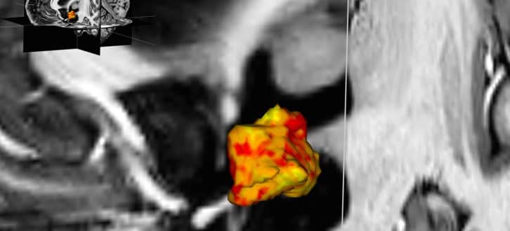 Blick von der linken Schläfe aus auf den linken Hypothalamus im Zentrum des Gehirns: Bei Personen mit Depressionen und bipolarer Störung sind vermutliche einige Regionen des Hypothalamus vergrößert (rot), einige sind jedoch auch verkleinert (gelb). Foto: Acta Psychiatrica Scandinavica