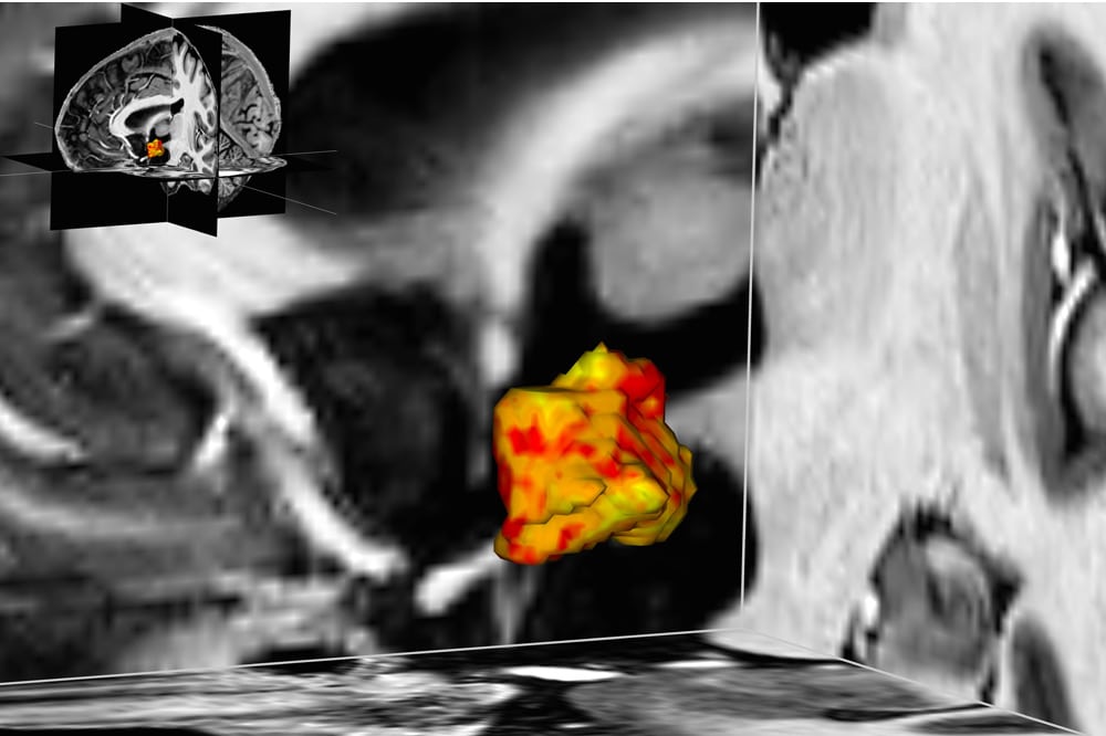 Blick von der linken Schläfe aus auf den linken Hypothalamus im Zentrum des Gehirns: Bei Personen mit Depressionen und bipolarer Störung sind vermutliche einige Regionen des Hypothalamus vergrößert (rot), einige sind jedoch auch verkleinert (gelb). Foto: Acta Psychiatrica Scandinavica