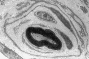 Elektronenmikroskopische Aufnahme eines an CMT1A erkrankten Nervs im Querschnitt (Vergrößerung 30.000 fach). An die innere mit Myelin (schwarzer Ring) ummantelte Nervenfaser lagern sich mehrere Schwann-Zellen ähnlich einer Zwiebelschale kreisförmig an Foto: Dr. Ruth Stassart