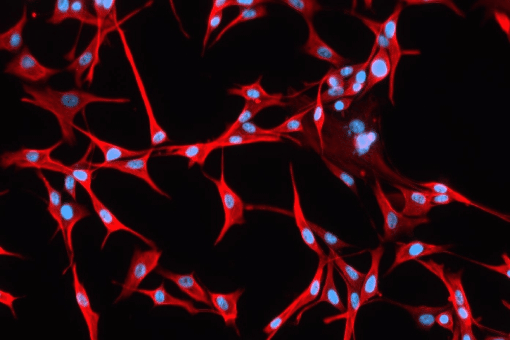 Zellkultur eines Glioblastoms: Blau sind die Zellkerne, rot die Zellkörper zu sehen. Sie wurden mit dem Protein Vimentin eingefärbt. Sehr starke Färbung bedeutet für Patienten nach einer aktuellen Studie eine sehr schlechte Prognose Foto: Klinik und Poliklinik für Neurochirurgie, Universitätsklinikum Leipzig