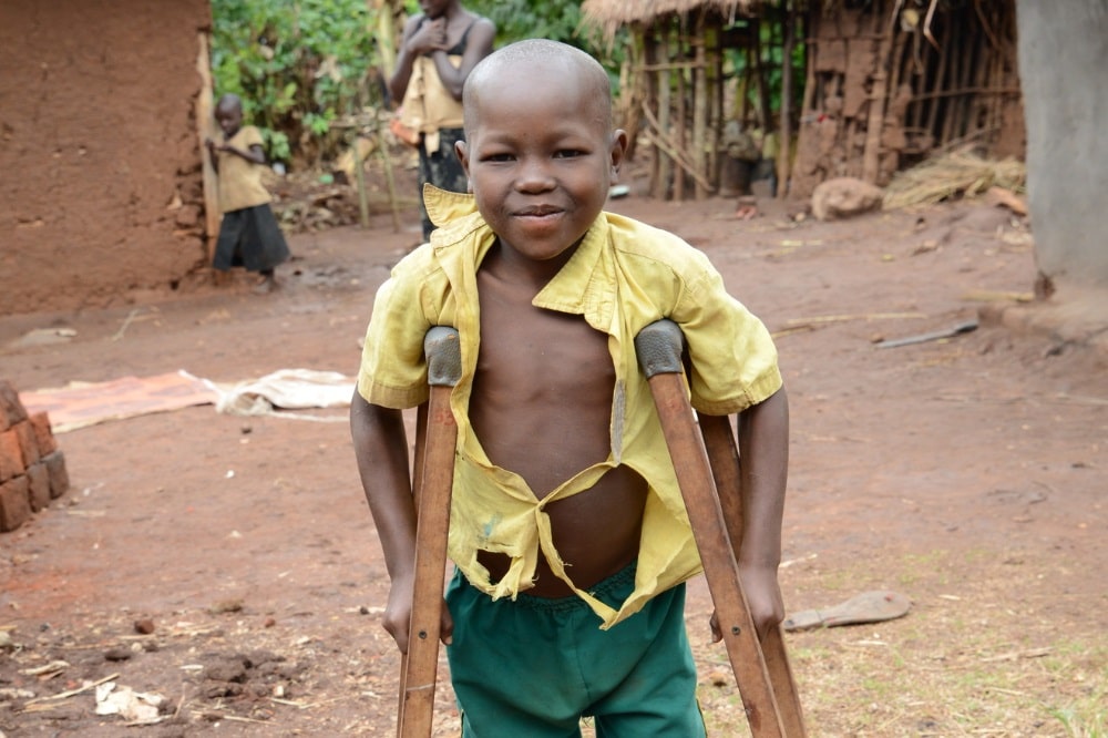 Denis hatte O-Bein. Nach zwei Operationen sind seine Beine nun gerade und er kann bald wieder laufen. © CBM