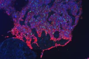 Fluoreszenzbild einer Tumorfront des Gebärmutterhals. Zellkerne wurden blau und sich teilende Zellen grün markiert. Tumorzellen, rot markiert, befallen und verdrängen gesundes Gewebe. Foto: Universitätsklinikum Leipzig