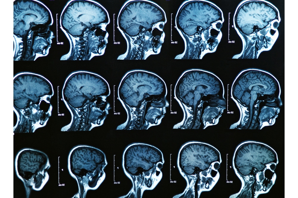 Computertomografische Aufnahme des Kopf-Hals-Bereiches. Foto: Colourbox