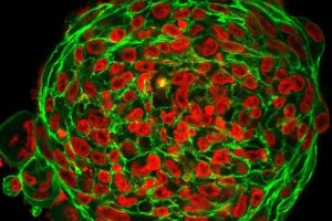 Aktin- und DNA-Färbung verraten die Struktur von 3D-Tumorclustern. Zellformen in Krebstumoren zeigen an, ob die Zellen beweglich sind. Foto: Universität Leipzig/Steffen Grosser