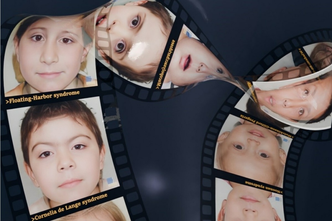 Photorealistische, synthetische Porträts unterschiedlicher Erkrankungen, die im Kontext der Studie diagnostiziert wurden. Die Bilder wurden mit GestaltGAN erzeugt und ermöglichen keinen Rückschluss auf die Personen. Weitere simulierte Patienten gibt es auf www.thispatientdoesnotexist.org. Foto: Universitätsklinikum Bonn (UKB) / Aron Kirchhoff